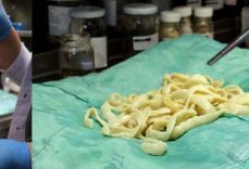 Tenya Nedir, Neden Olur? Tenya Nasıl Dökülür, Tenya Tedavisi Nasıl Yapılır?