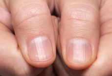 Tırnak yüzeyindeki yatay ve dikey çizgilerin sebebi ne?
