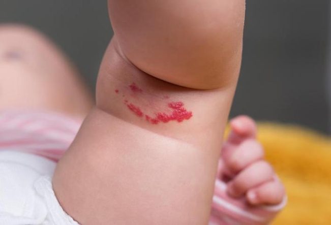 Hemanjiom Nedir? Hemanjiom Belirtileri Nelerdir, Tedavisi Nasıl Yapılır?